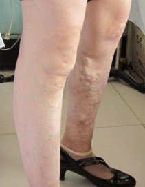 下肢静脉曲张成都患者患肢会发黑吗？