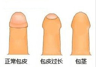 包皮过长会影响到生育吗