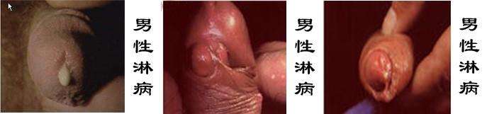 男性泌尿感染
的症状和图片