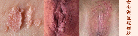 男性尖锐湿疹的症状与图片